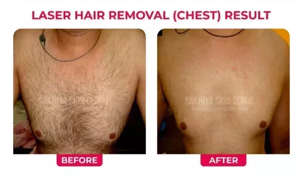 sakhiya-skin-clinic-best-skin-clinic-for-laser-hair-removal-in-surat-big-4