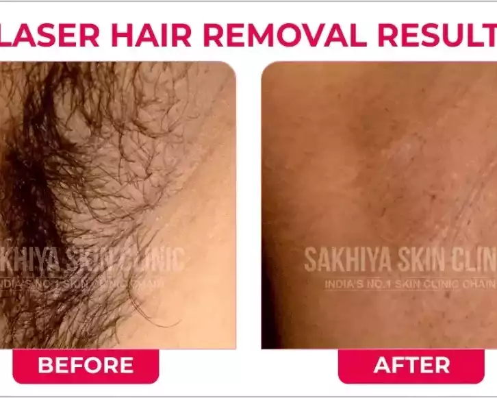 sakhiya-skin-clinic-best-skin-clinic-for-laser-hair-removal-in-surat