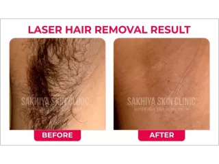 sakhiya-skin-clinic-best-skin-clinic-for-laser-hair-removal-in-surat-small-0