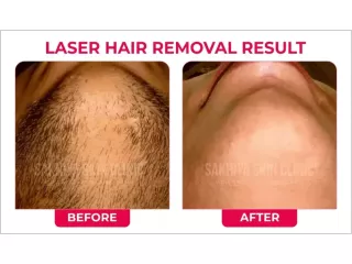 sakhiya-skin-clinic-best-skin-clinic-for-laser-hair-removal-in-surat-small-1