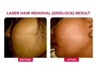 sakhiya-skin-clinic-best-skin-clinic-for-laser-hair-removal-in-surat-small-2