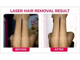 sakhiya-skin-clinic-best-skin-clinic-for-laser-hair-removal-in-surat-small-3