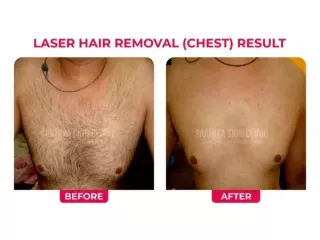 sakhiya-skin-clinic-best-skin-clinic-for-laser-hair-removal-in-surat-small-4