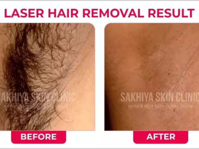 sakhiya-skin-clinic-best-skin-clinic-for-laser-hair-removal-in-surat