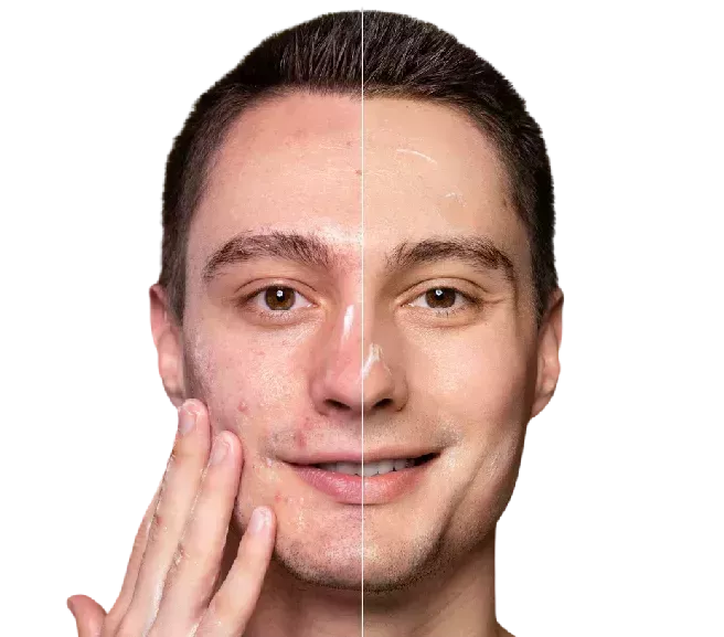 acne-scar-treatment-in-noida-dr-radha-sharma-big-0