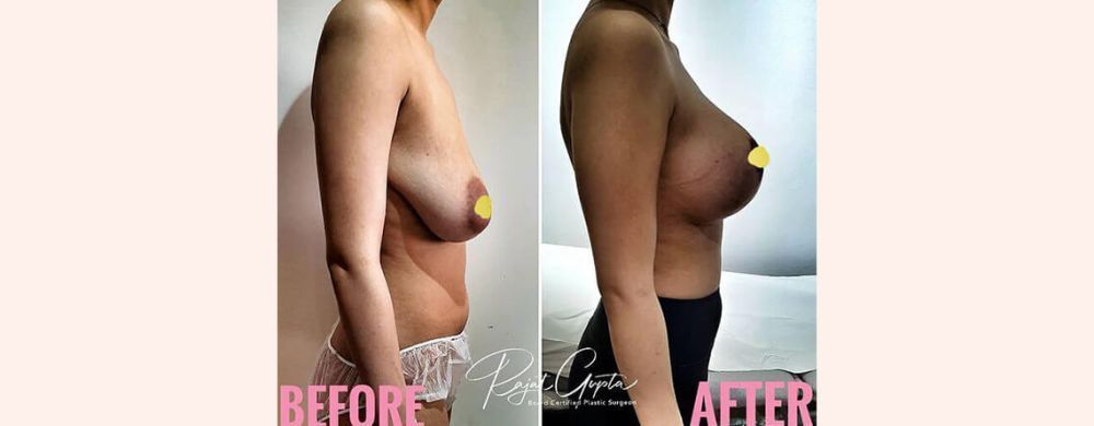 what-you-need-to-know-about-breast-lift-scars-big-0