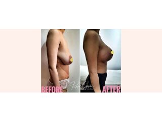 what-you-need-to-know-about-breast-lift-scars-small-0