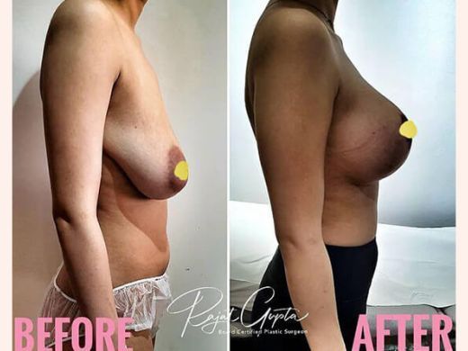 what-you-need-to-know-about-breast-lift-scars
