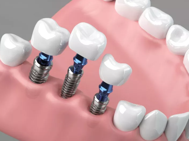 trusted-root-canal-specialist-in-ahmedabad-the-dental-wellness-centre