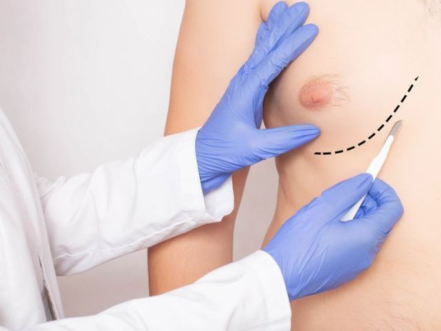 gynecomastia-surgery-in-mumbai-hair-and-shape-clinic