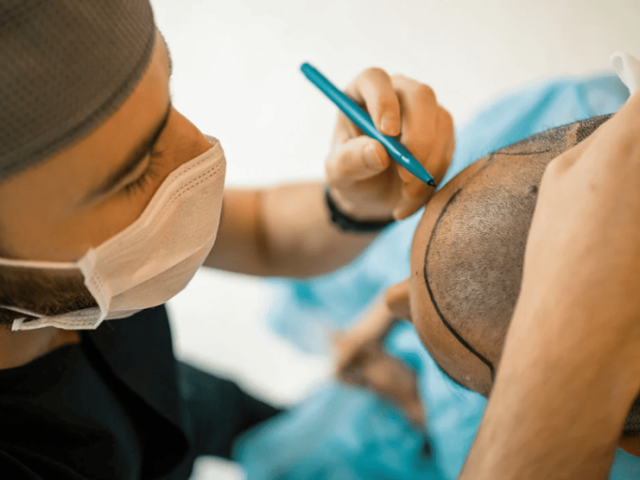 get-fut-hair-transplant-in-mumbai-hair-and-shape-clinic