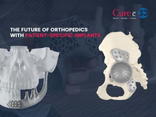 the-future-of-orthopedics-with-patient-specific-implants-small-0