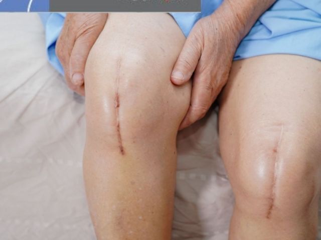 leading-partial-knee-replacement-surgery-saviour-hospital