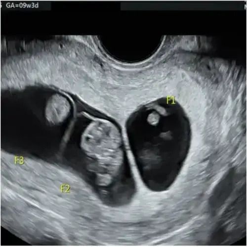best-twin-pregnancy-scan-test-fetal-india-big-0