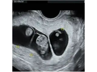 best-twin-pregnancy-scan-test-fetal-india-small-0