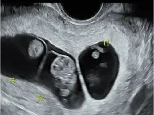 best-twin-pregnancy-scan-test-fetal-india