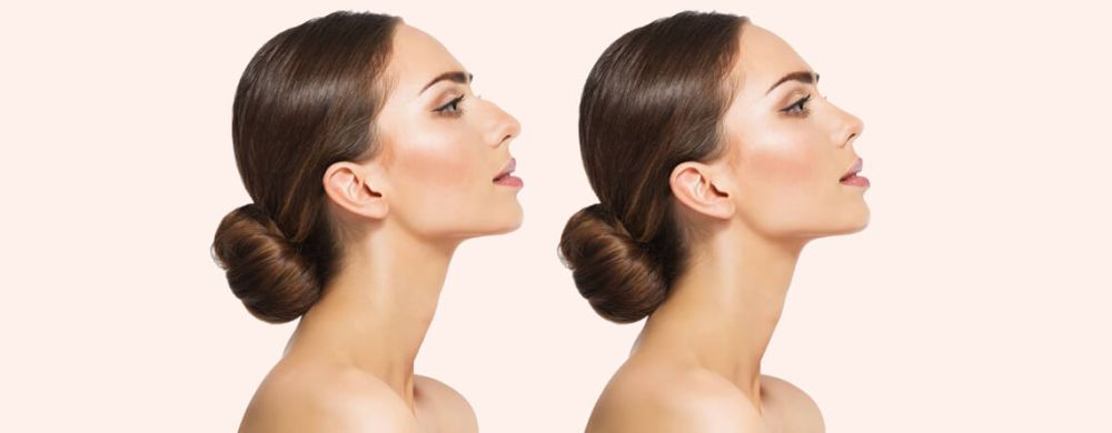 how-long-does-a-nose-job-take-to-heal-big-0