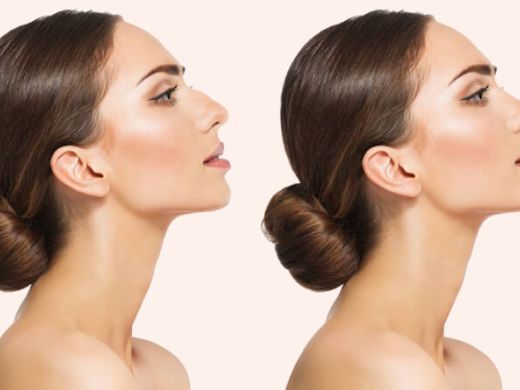 how-long-does-a-nose-job-take-to-heal