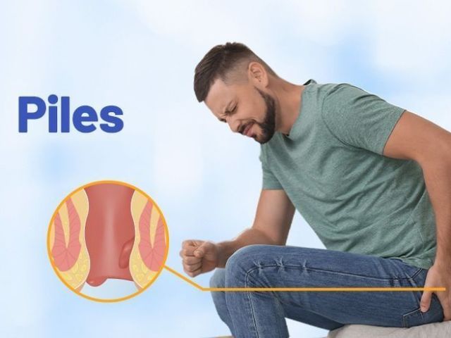 best-ayurvedic-treatment-for-fissure-for-long-term-relief