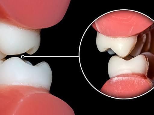root-canal-treatment-in-jaipur