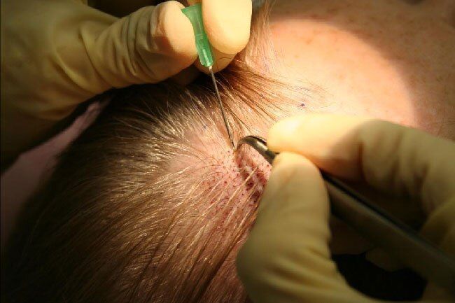 get-advanced-fue-hair-transplant-in-mumbai-big-0