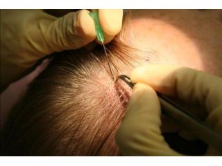 get-advanced-fue-hair-transplant-in-mumbai-small-0