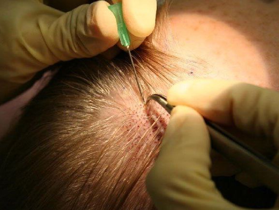get-advanced-fue-hair-transplant-in-mumbai