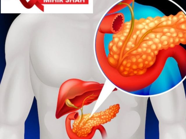 advanced-pancreatic-cancer-care-in-ahmedabad