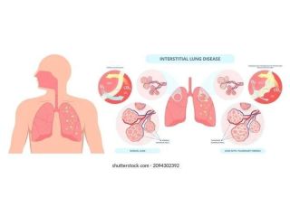 top-bronchoscopy-specialist-in-jaipur-asthma-bhawan-small-0