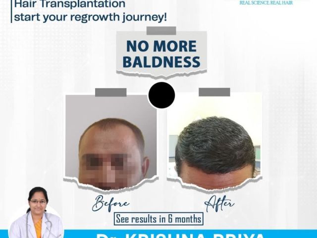 top-hair-transplant-clinic-in-rajahmundry