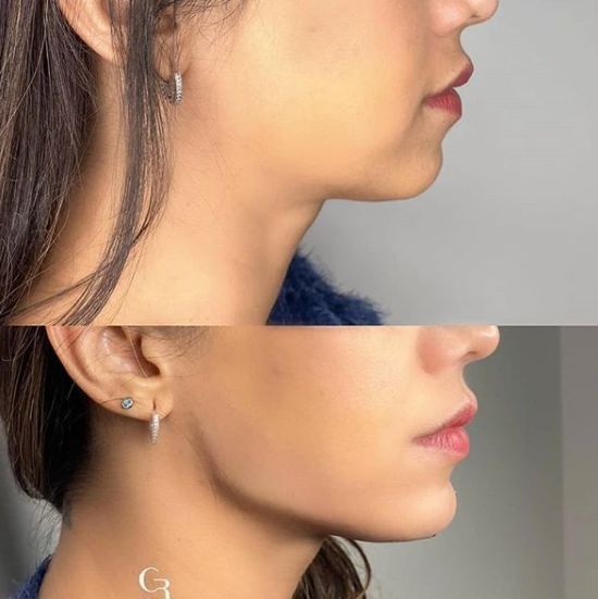 facelift-surgery-cost-in-mumbai-hair-shape-clinic-big-0