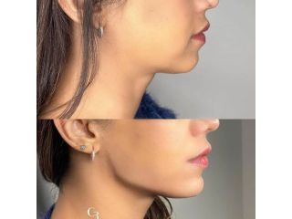 facelift-surgery-cost-in-mumbai-hair-shape-clinic-small-0