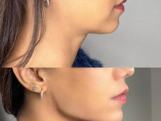 facelift-surgery-cost-in-mumbai-hair-shape-clinic
