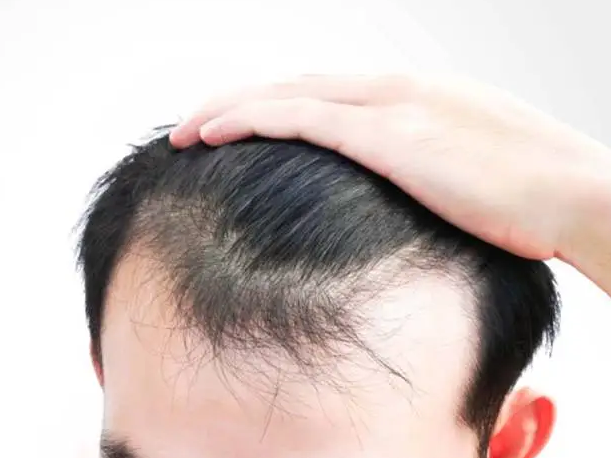best-fue-hair-transplant-in-gurgaon-at-sb-trichology