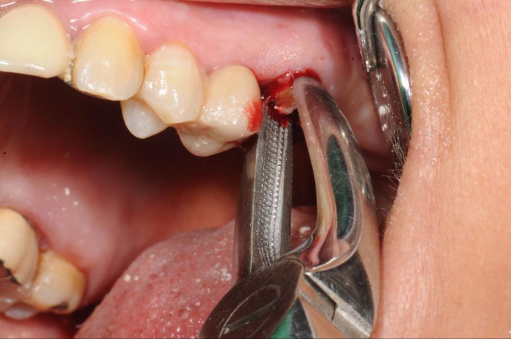 surgical-tooth-extraction-in-sector-12-noida-big-0