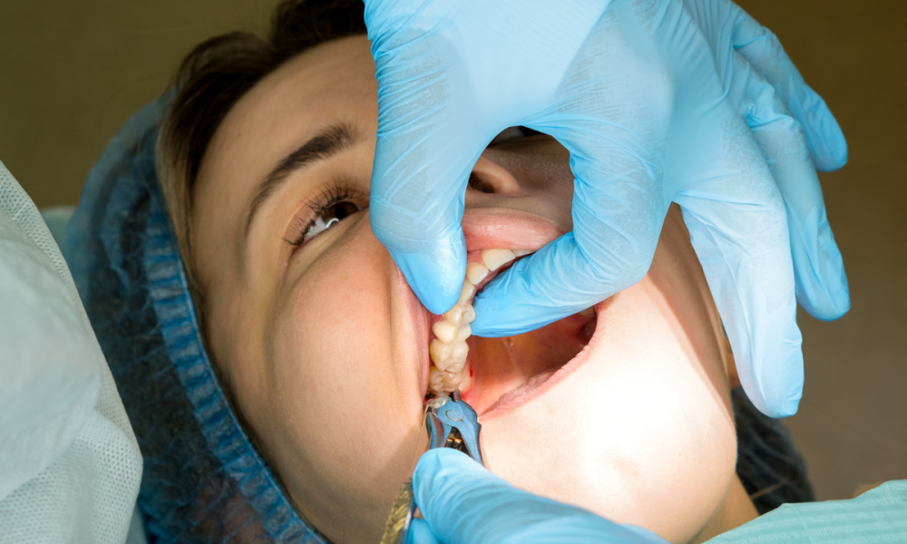 surgical-tooth-extraction-in-sector-12-noida-big-1