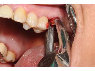 surgical-tooth-extraction-in-sector-12-noida-small-0