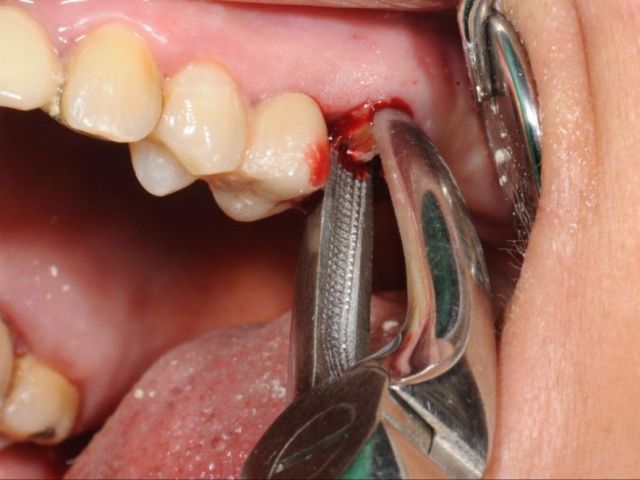 surgical-tooth-extraction-in-sector-12-noida
