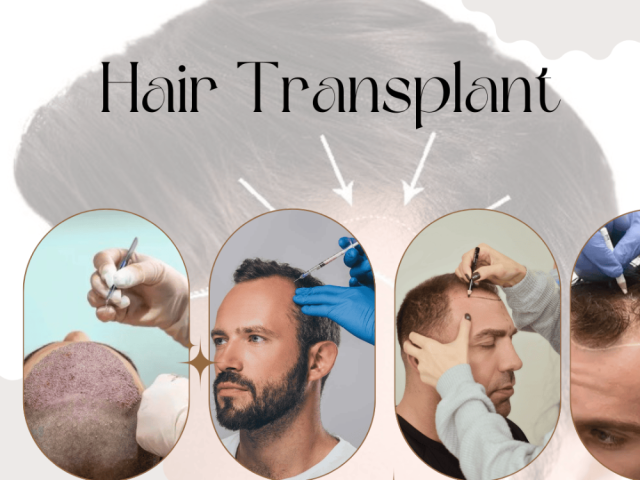 hair-transplant-in-ahmedabad-fue-dhi-expert-clinic