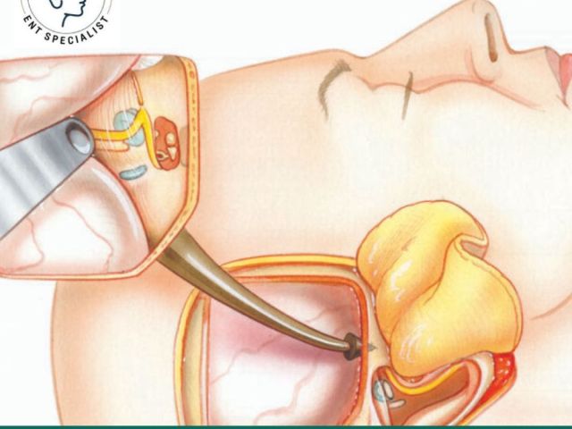 advanced-ent-care-for-facial-nerve-decompression-in-ahmedabad
