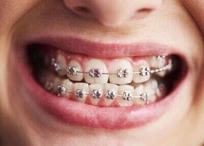 affordable-dental-braces-treatment-in-chetla-by-experts-big-0