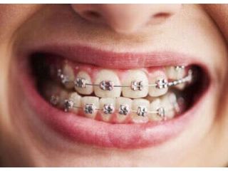 affordable-dental-braces-treatment-in-chetla-by-experts-small-0