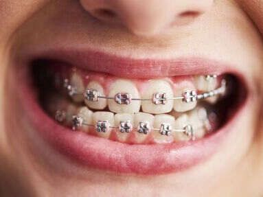 affordable-dental-braces-treatment-in-chetla-by-experts