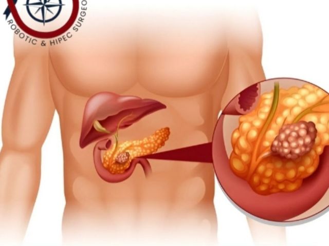 pancreatic-cancer-surgeon-in-ahmedabad-for-advanced-treatment