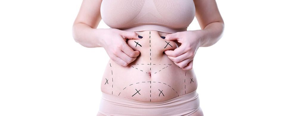 can-i-get-multiple-areas-of-liposuction-at-once-big-0