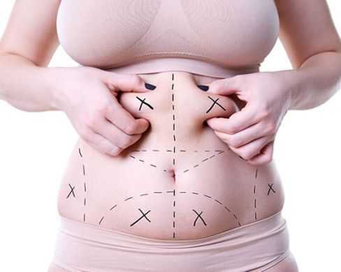 can-i-get-multiple-areas-of-liposuction-at-once