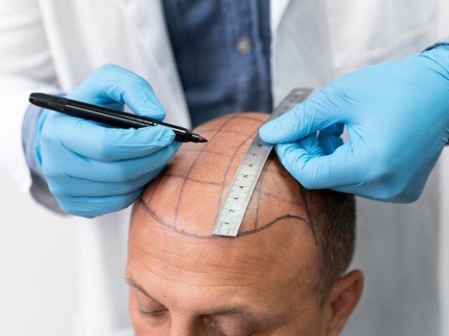 permanent-hair-transplant-solutions-in-allahabad