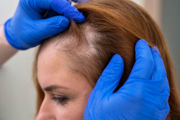 hair-loss-treatment-at-dermapuritys-womens-day-special-offers-big-0