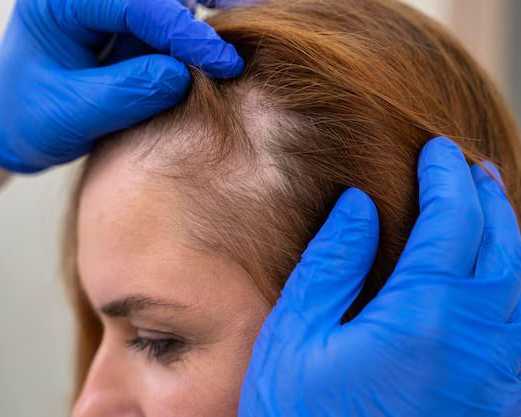 hair-loss-treatment-at-dermapuritys-womens-day-special-offers