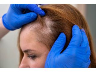 hair-loss-treatment-at-dermapuritys-womens-day-special-offers-small-0